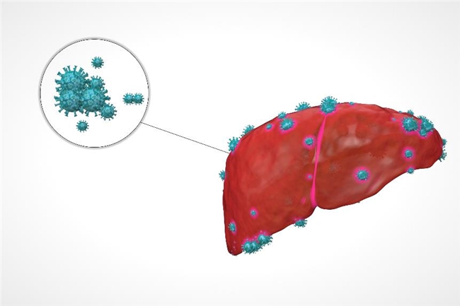 肝癌的治疗方法有什么，阿可拉定打开晚期肝癌治疗新思路(图1)