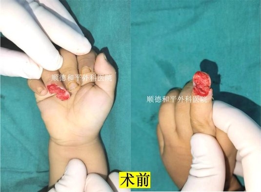 和平医院成功为2岁男童实现“手指再生”_手外科医院咨询(图1)