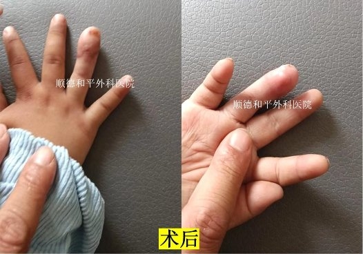 和平医院成功为2岁男童实现“手指再生”_手外科医院咨询(图2)