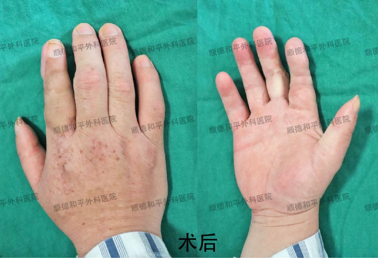 新疆患者失去手指心生自卑，远赴广东手指再造＿手外科医院咨询(图2)