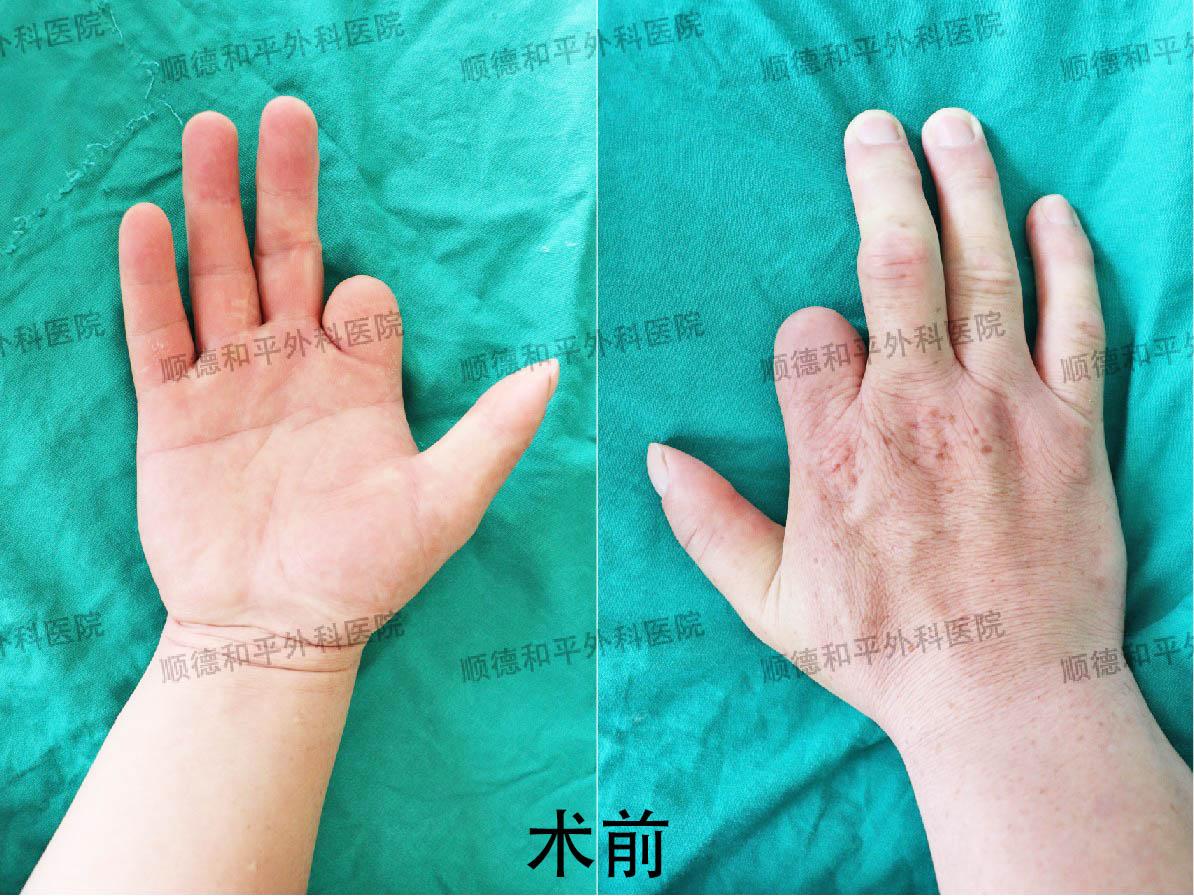 新疆患者失去手指心生自卑，远赴广东手指再造＿手外科医院咨询(图1)