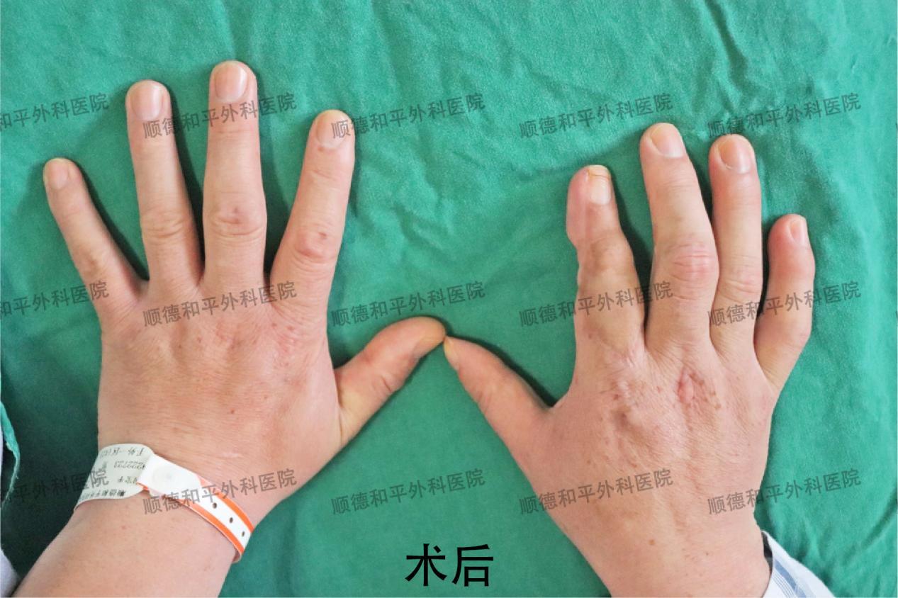 新疆患者失去手指心生自卑，远赴广东手指再造＿手外科医院咨询(图3)