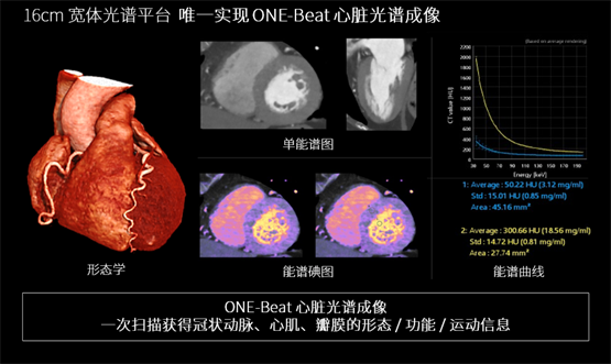 登陆中国,首款16cm光谱成像、超高清宽体CT国产上市(图3) 登陆中国,首款16cm光谱成像、超高清宽体CT国产上市(图3)