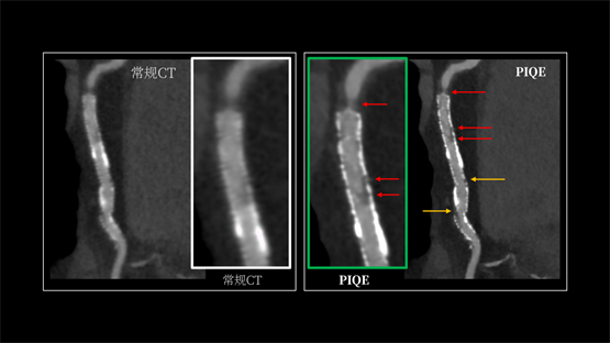 登陆中国,首款16cm光谱成像、超高清宽体CT国产上市(图4) 登陆中国,首款16cm光谱成像、超高清宽体CT国产上市(图4)