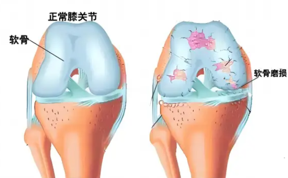 全网10大品牌氨糖软骨素实测盘点:关节养护选对款,高含量才是硬实力!(图4) 全网10大品牌氨糖软骨素实测盘点:关节养护选对款,高含量才是硬实力!(图4)